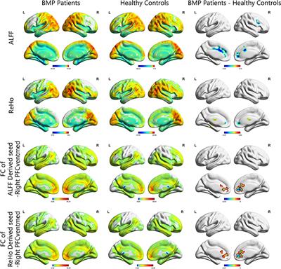 Altered brain functional activity and connectivity in bone metastasis pain of lung cancer patients: A preliminary resting-state fMRI study